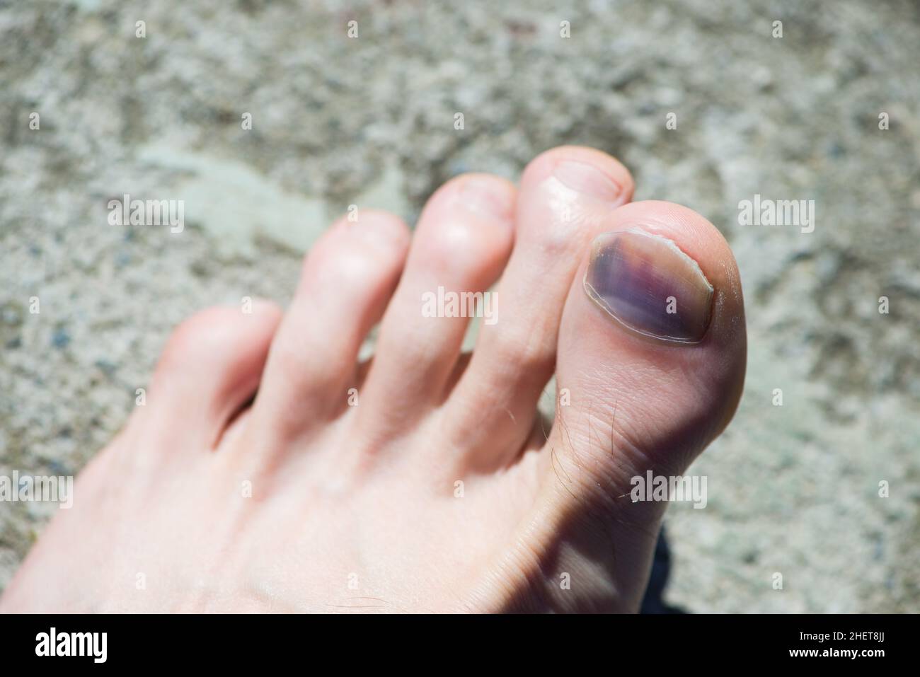 Blessure aux ongles des orteils Banque de photographies et d’images à — free download