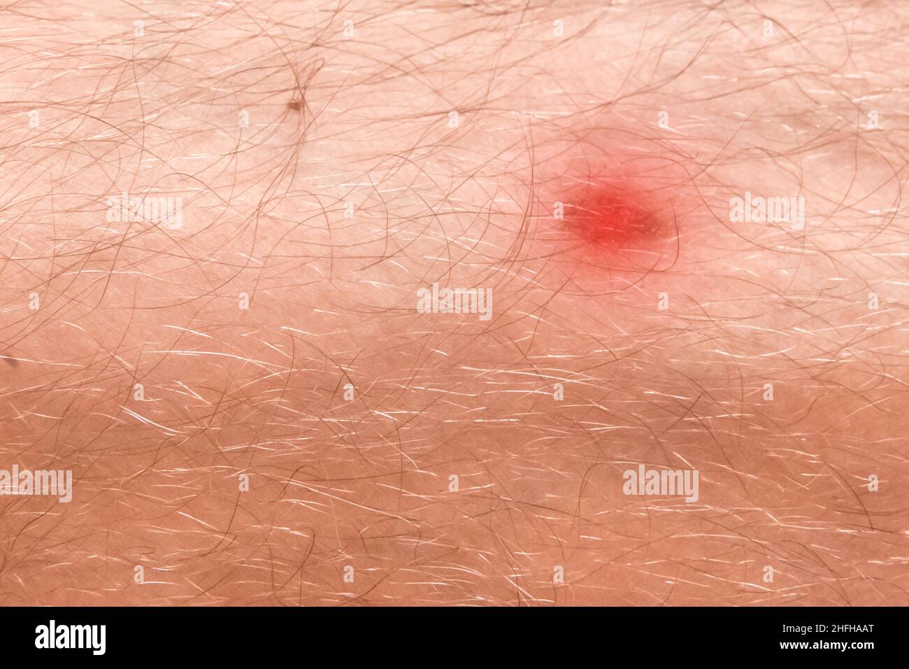 Maladie de la jambe rouge Banque de photographies et d'images à haute  résolution - Alamy