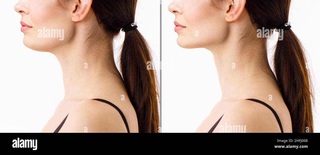 Un portrait rapproché d'une femme âgée avant et après la procédure de rajeunissement du visage.Correction de la liposuccion de la forme du menton du cou.Le résultat de Banque D'Images