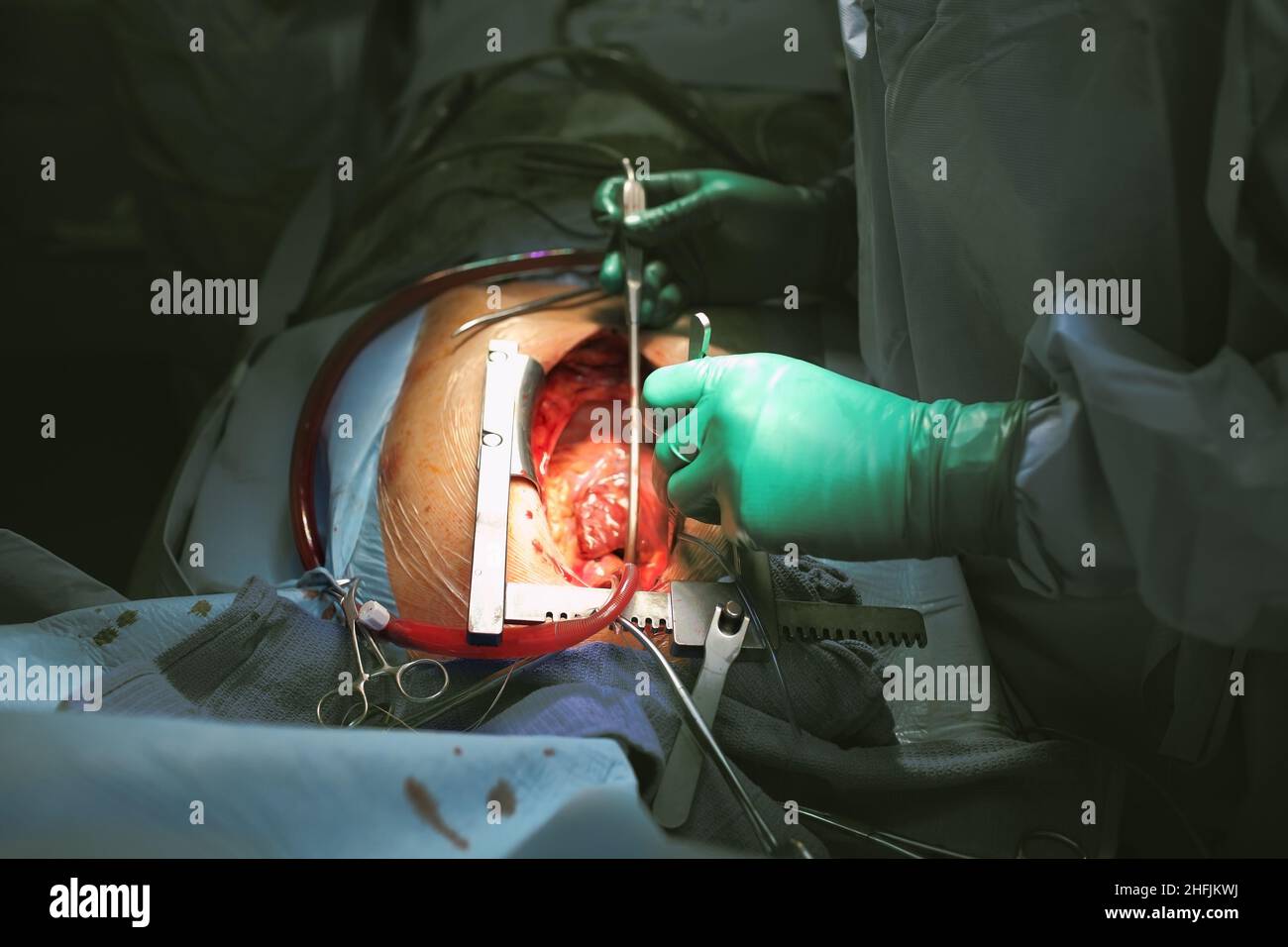 Chirurgie effectuée par le chirurgien sur le coeur ouvert avec des tubes et des outils connectés. Banque D'Images