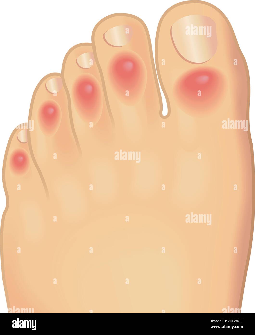 Illustrations médicales des orteils affligés des chilblains. Illustration de Vecteur
