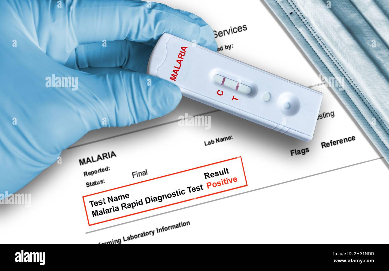 Résultat positif du test de paludisme indiquant les parasites du paludisme en utilisant un dispositif de test de diagnostic rapide tenu à la main dans un gant médical avec un mas du visage médical Banque D'Images