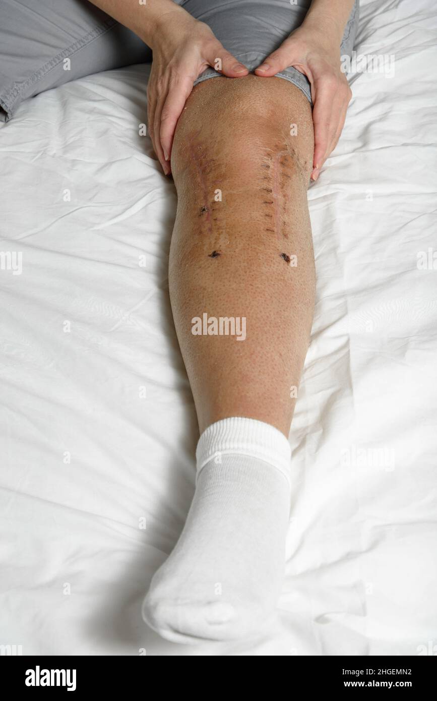 Femme massante suture postopératoire après une fracture de jambe.Concept de réadaptation et de récupération après chirurgie sur le genou cassé.Gros plan Banque D'Images