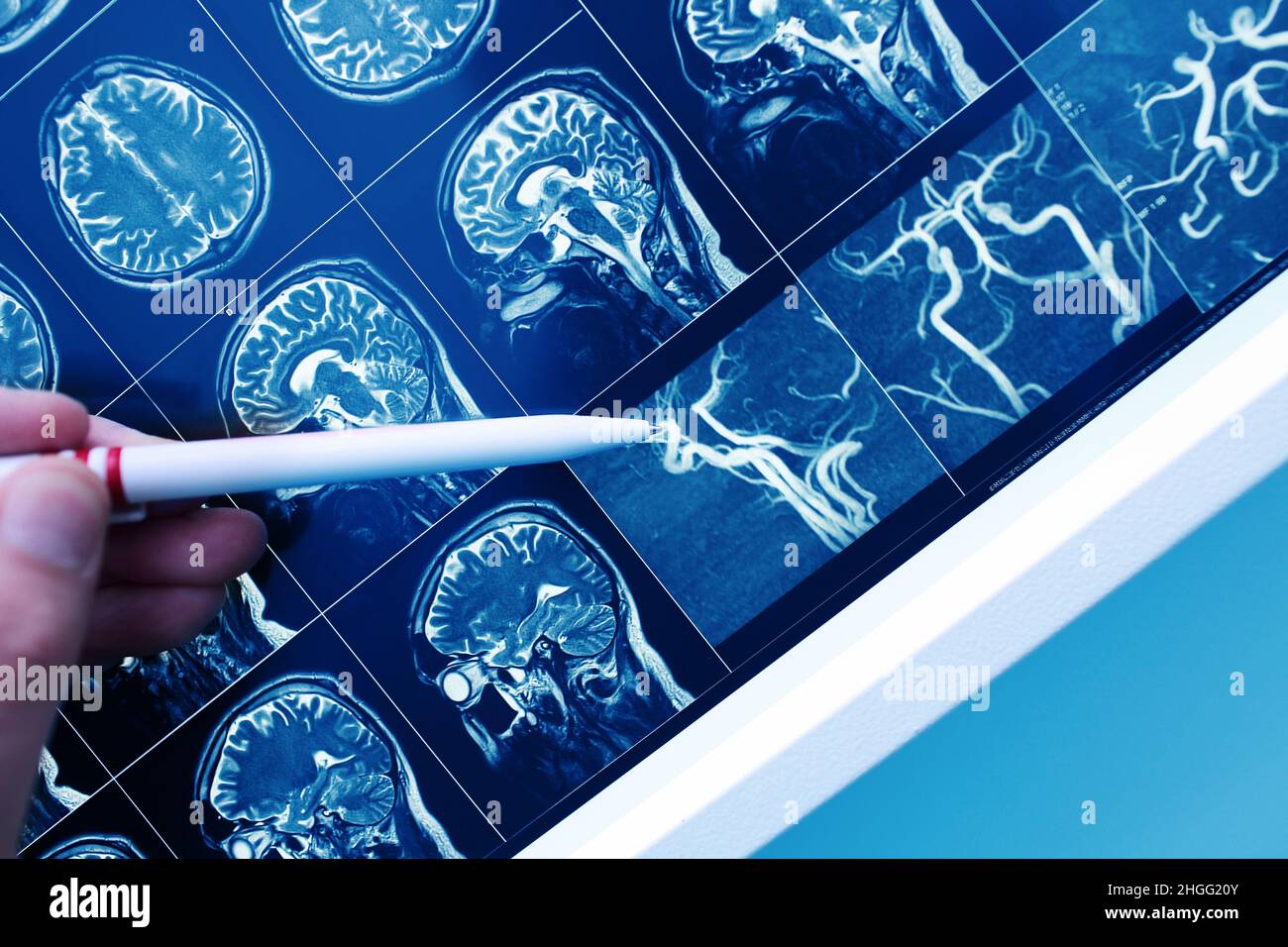 Médecin pointant avec un stylo vers le vaisseau sanguin cérébral sur l'image IRM. Banque D'Images