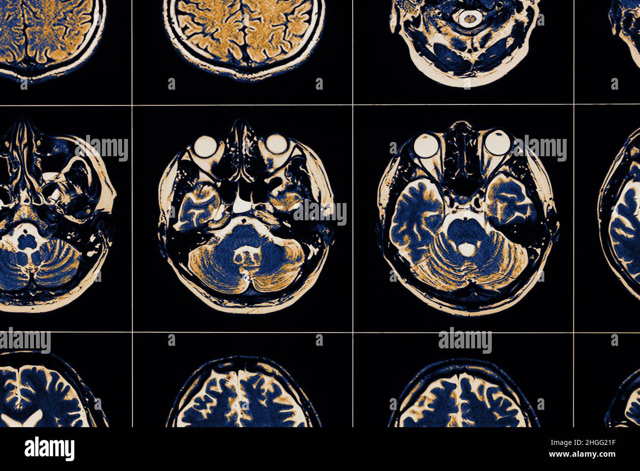 Image IRM du cerveau humain en gros plan. Banque D'Images