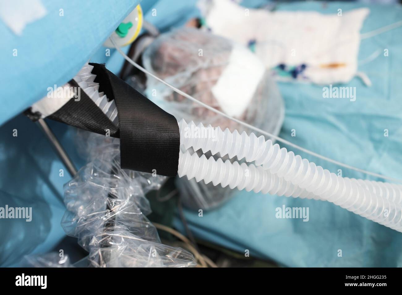 Patient en sommeil pendant une intervention chirurgicale connecté au ventilateur. Banque D'Images