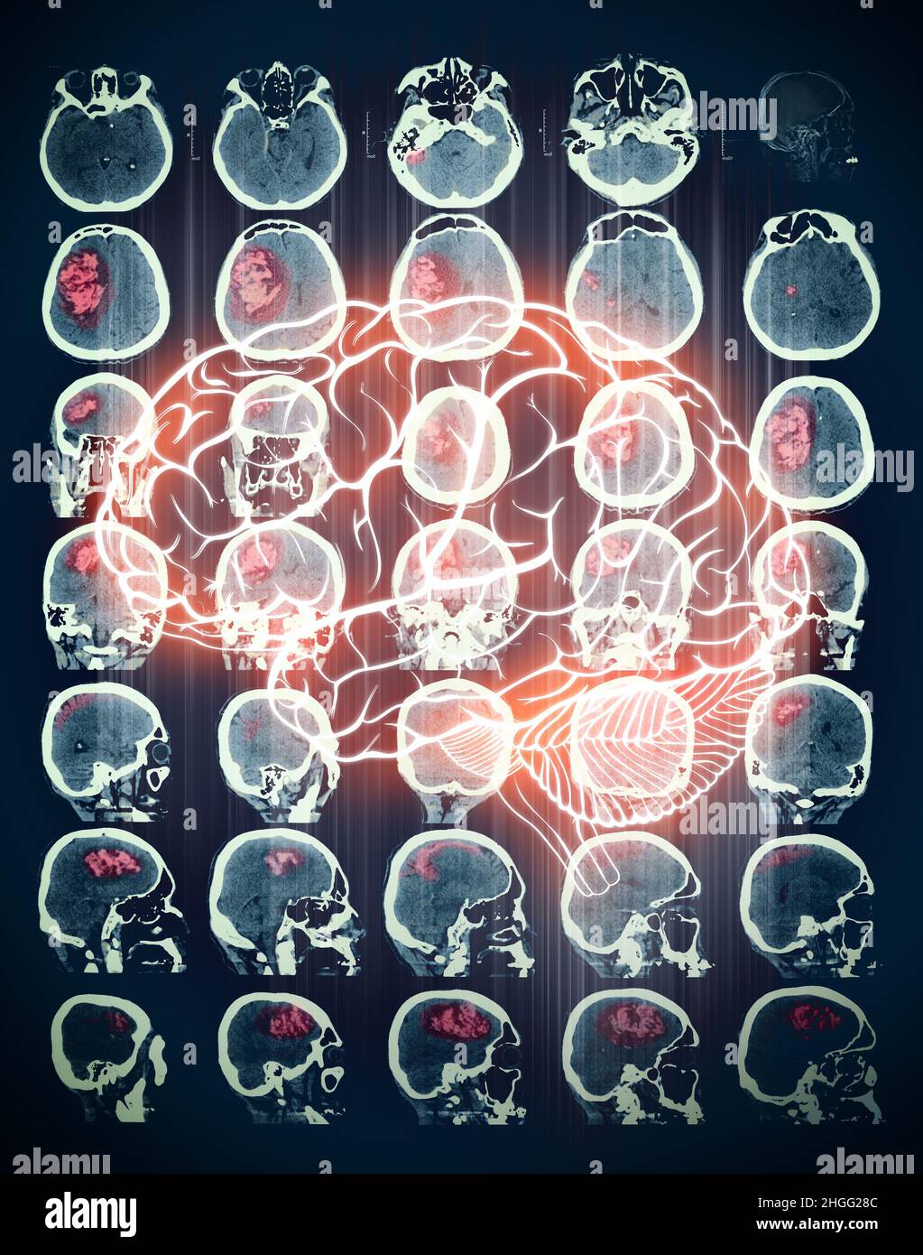 Zone marquée en rouge sur l'acquisition CT du cerveau humain. Banque D'Images