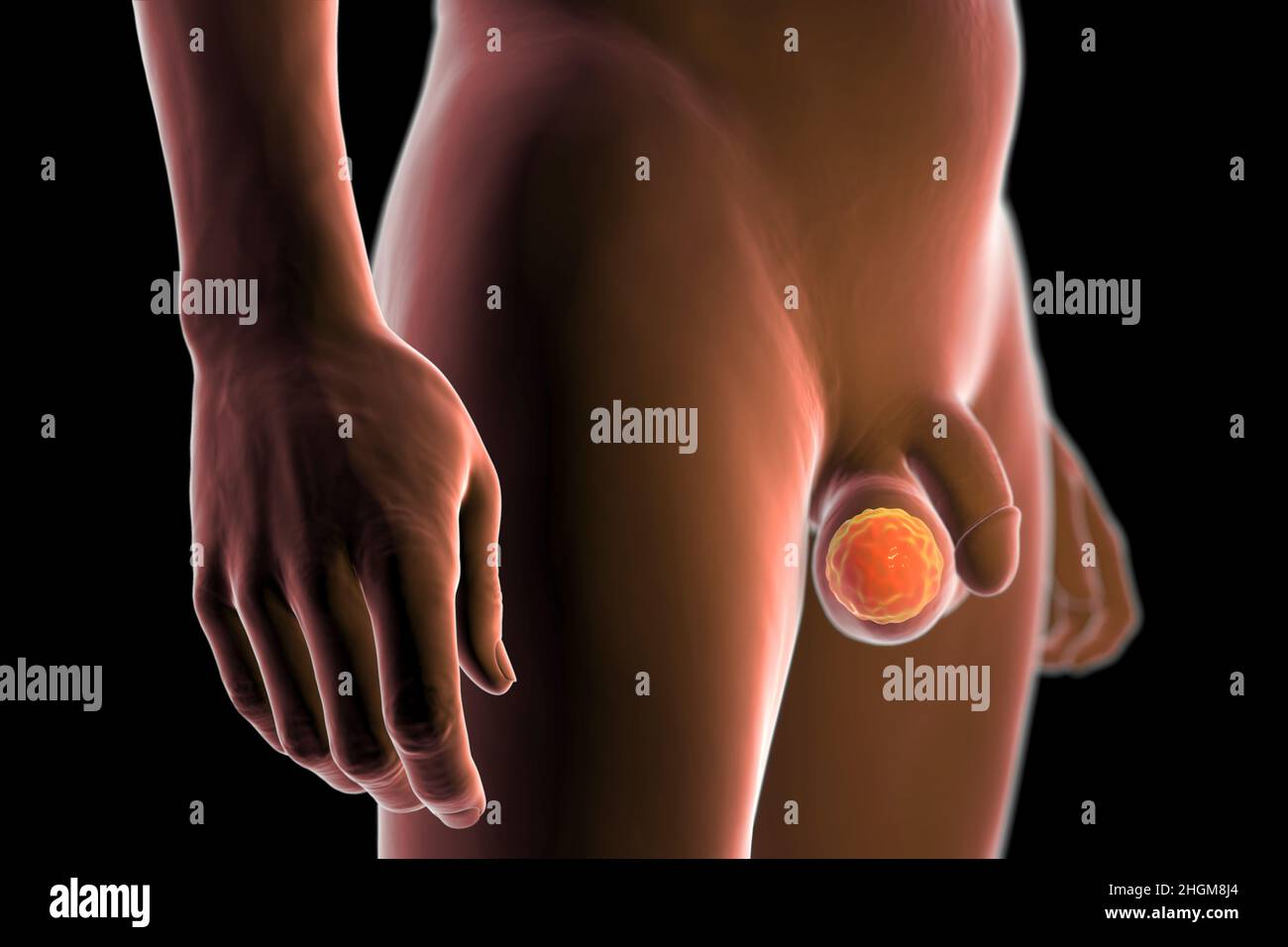 Cancer du testicule, illustration Banque D'Images