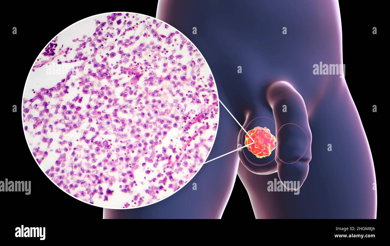 Cancer du testicule, illustration et micrographe léger Banque D'Images