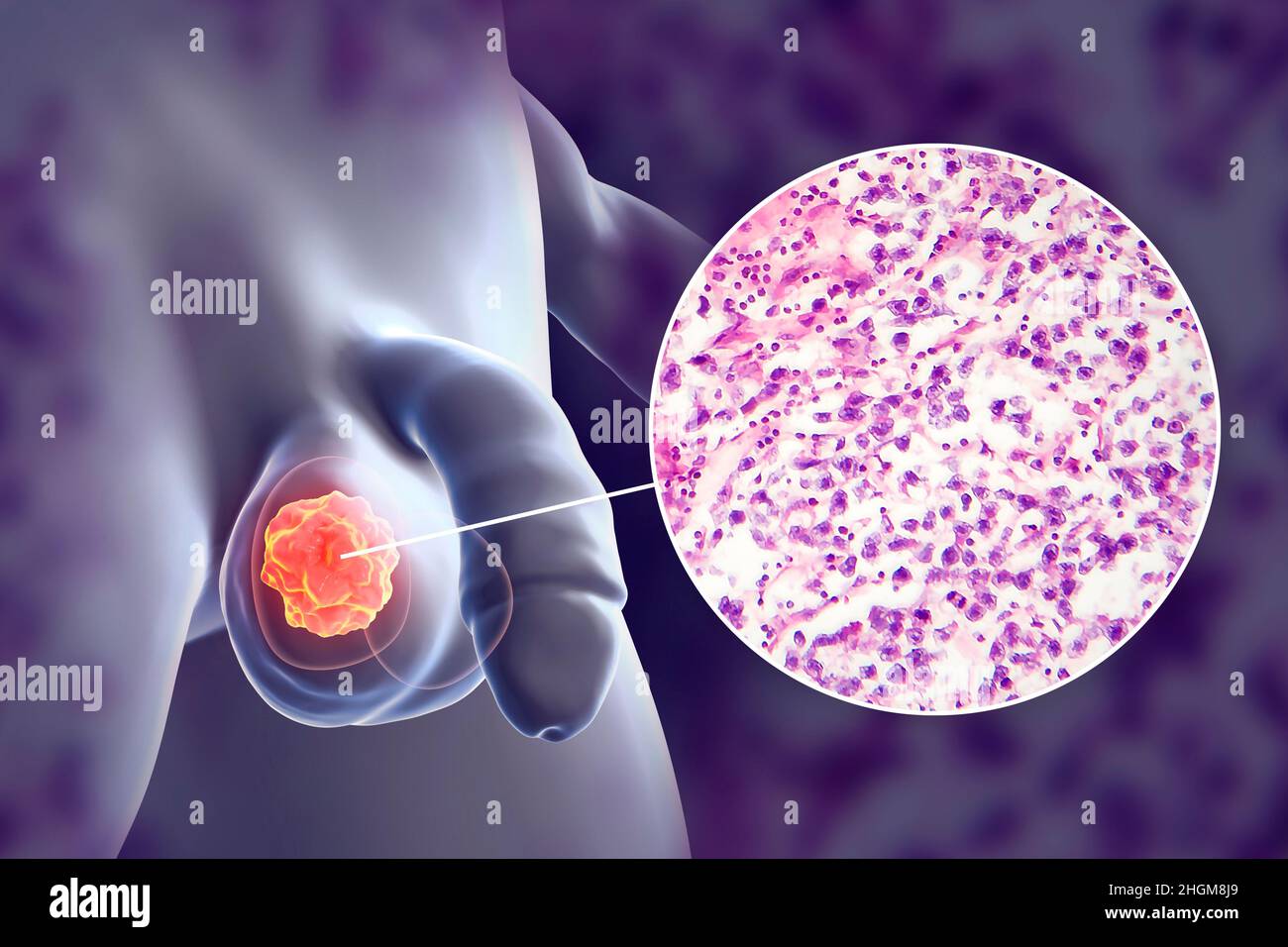 Cancer du testicule, illustration et micrographe léger Banque D'Images