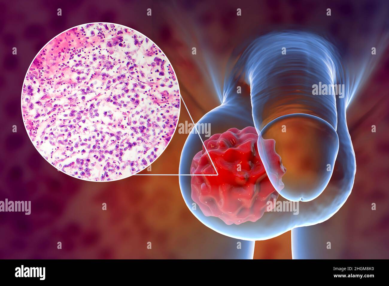 Cancer du testicule, illustration et micrographe léger Photo Stock Alamy