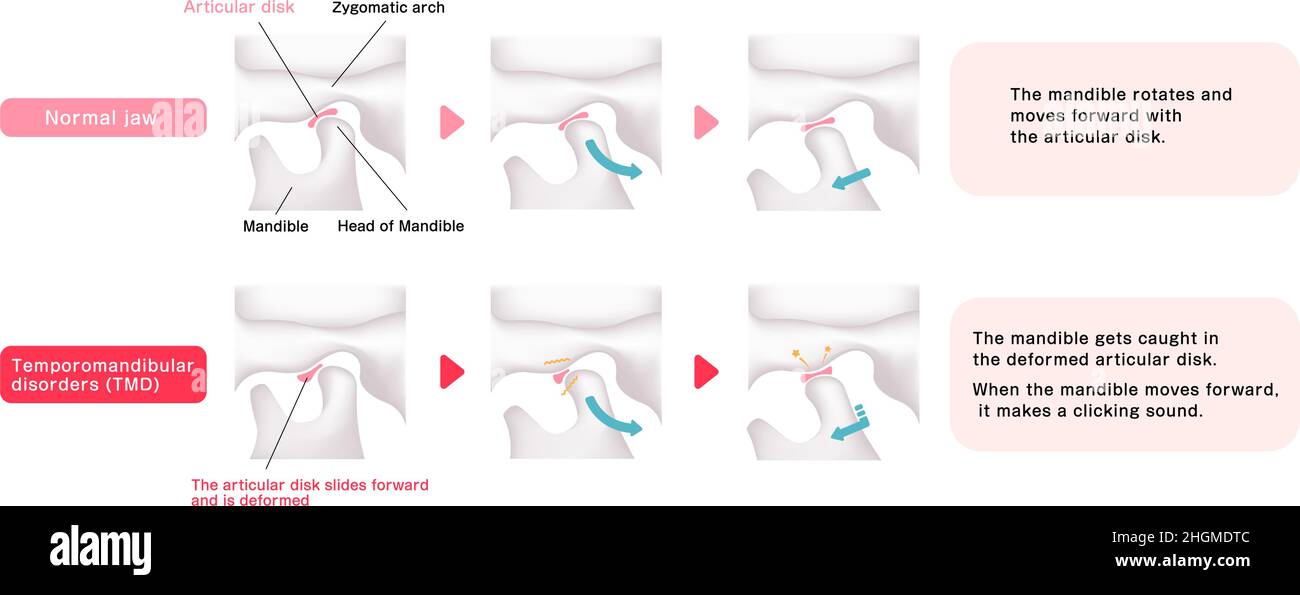 Illustration comparative des troubles normaux de la mâchoire et de la temporomandibule (TMD) Illustration de Vecteur