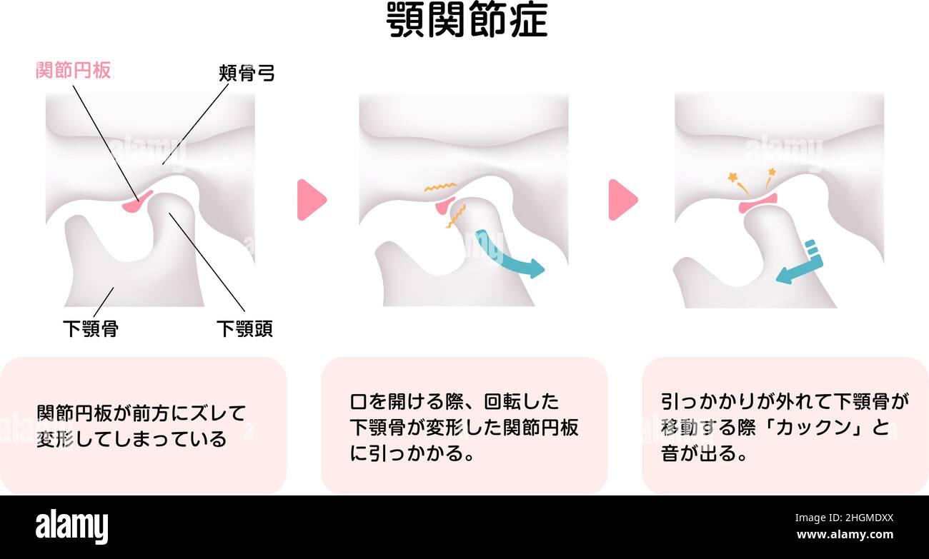 Illustration de la cause des troubles temporomandibulaires (TMD) Illustration de Vecteur