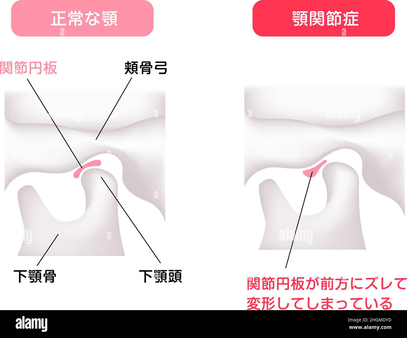 Illustration comparant les formes du disque articulaire ( troubles de la mâchoire normale et troubles temporo-mandibulaires ) Illustration de Vecteur