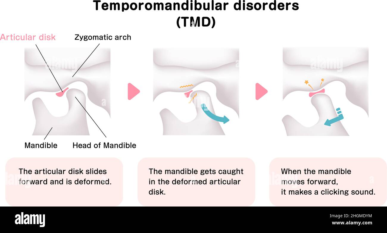 Illustration de la cause des troubles temporomandibulaires (TMD) Illustration de Vecteur