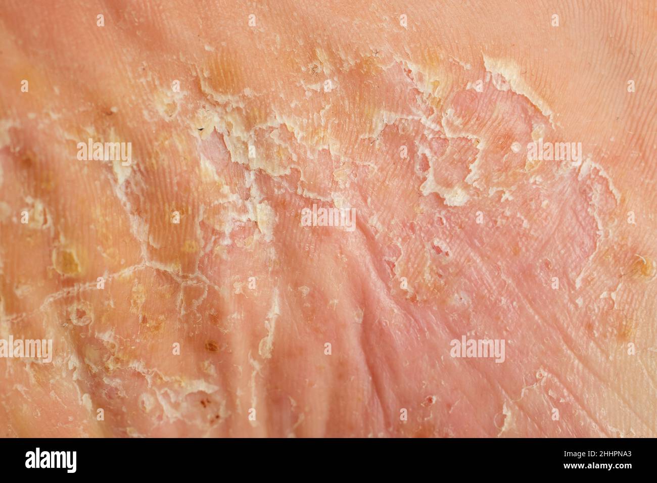 lésions graves du psoriasis pustulaire sur la semelle du pied Banque D'Images