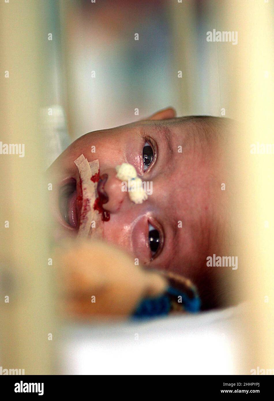 BÉBÉ VASILE BUCATARU DE L'ORPHELINAT ROUMAIN DANS LA SALLE DE RÉCUPÉRATION APRÈS UNE CHIRURGIE CORRECTIVE PAR LE CHIRURGIEN BRITANNIQUE OLIVER FENTON POUR RÉPARER SA LÈVRE DE FENTE.BRASOV HÔPITAL.ROUMANIE.Photo : GARYROBERTSPHOTOGRAPHY.COM Banque D'Images