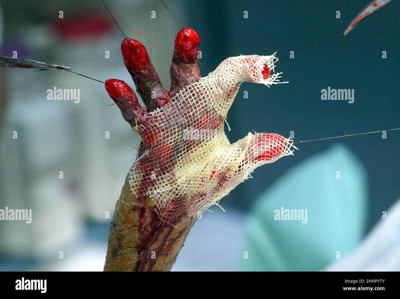 LA MAIN LIBÉRÉE DE GABRIEL SARARU AVEC DES BANDAGES DONT LES CHIFFRES SONT SÉPARÉS PAR DES POINTS CHIRURGICAUX TENUS PAR DES FORCEPS DANS LES MAINS DES CHIRURGIENS.L'OPÉRATION DE LIBÉRER SA MAIN ET SES CHIFFRES ÉTAIT NÉCESSAIRE CAR SES MAINS ONT ÉTÉ COCONOYÉES DANS LA PEAU FORMÉE EN RAISON DE LA CONDITION ÉPIDERMOLYSE BULLOSA DYSTROPHICA.IL A ÉTÉ OPÉRÉ PAR LE CHIRURGIEN BRITANNIQUE OLIVER FENTON QUI VOYAGE EN ROUMANIE CHAQUE ANNÉE POUR OPÉRER SUR DES ENFANTS ROUMAINS AFIN DE RECTIFIER LEURS DÉFORMATIONS, LEUR DONNANT UN ESPOIR PLUS BRILLANT POUR L'AVENIR .ROUMANIE.Photo : GARYROBERTSPHOTOGRAPHY.COM Banque D'Images