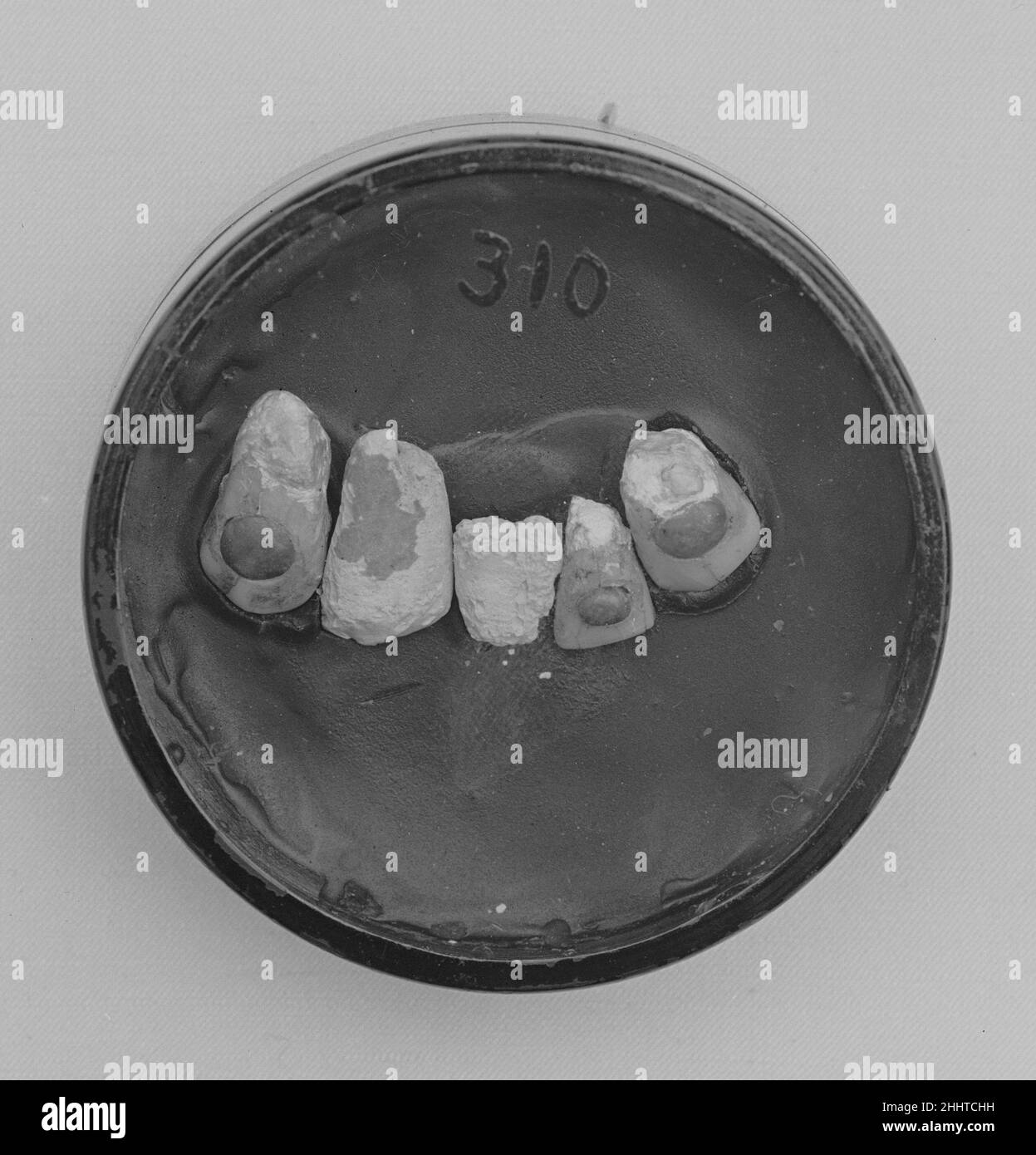 Dent humaine incrusté de jadeite (une des trois) Mexique.Dent humaine incrusté de jadeite (une de trois).Mexique.Jadeite, vert pois.Jade Banque D'Images