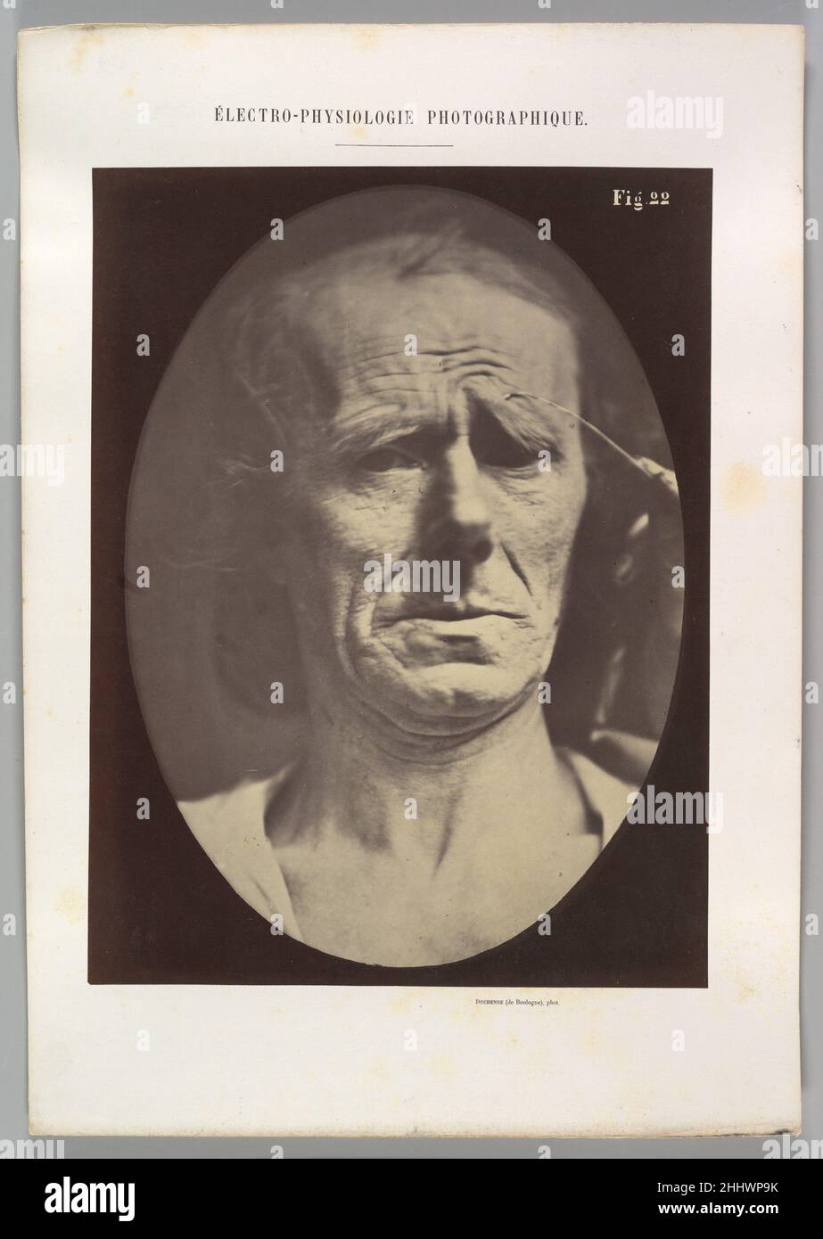 Figure 22: Aucune expression douloureuse 1854–56, imprimé 1862 Guillaume-Benjamin-Amand Duchenne de Boulogne Français.Figure 22: Aucune expression douloureuse 623040 Banque D'Images