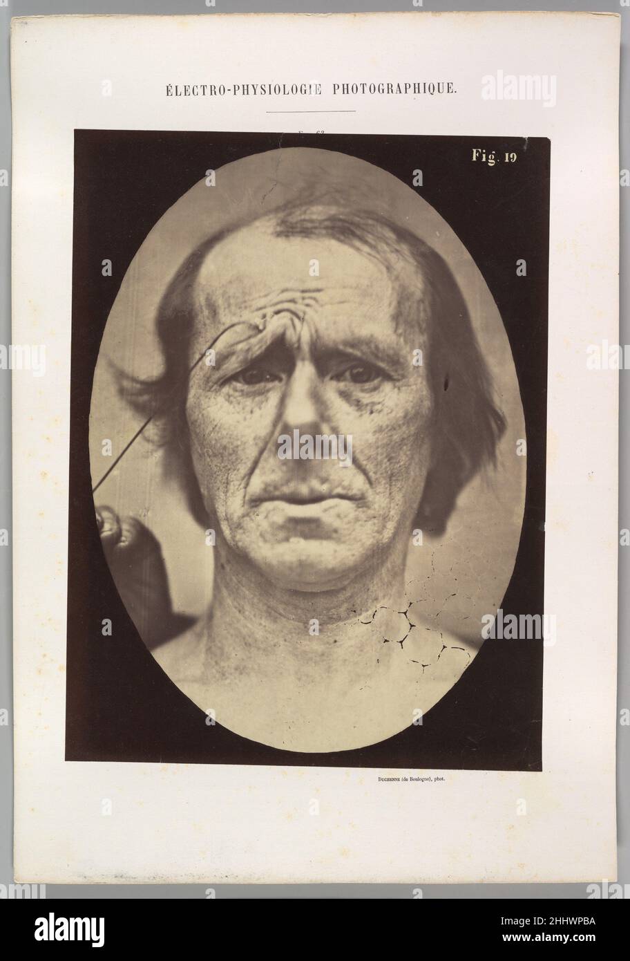 Figure 19 : souffrance 1854–56, imprimé en 1862 Guillaume-Benjamin-Amand Duchenne de Boulogne Français.Figure 19 : souffrance 623037 Banque D'Images