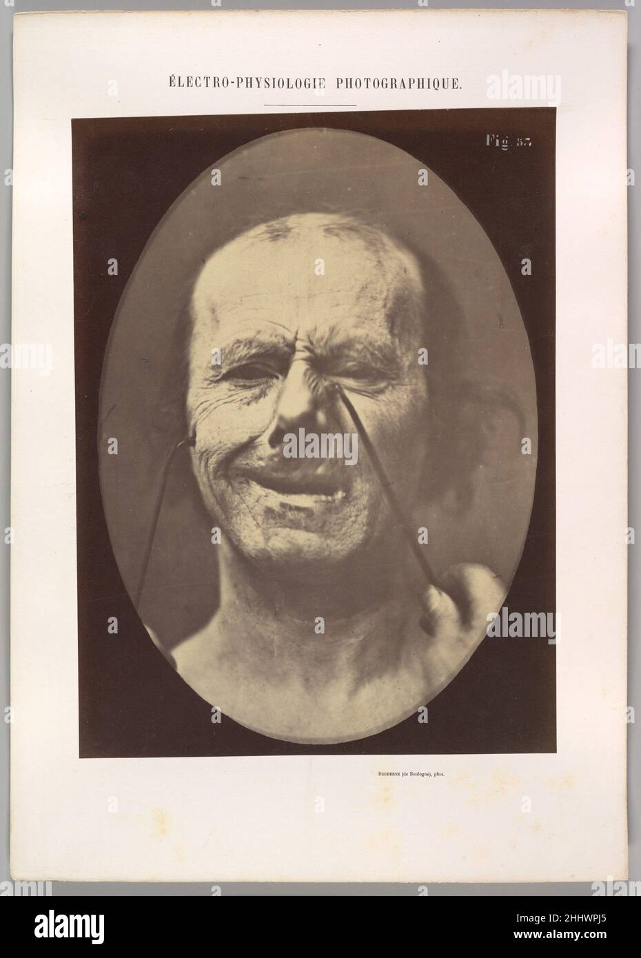 Figure 53: Rire et rires faux 1854–56, imprimé en 1862 Guillaume-Benjamin-Amand Duchenne de Boulogne Français.Figure 53 : rire et rires faux 623055 Banque D'Images
