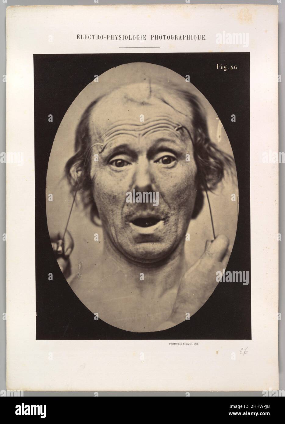 Figure 56 : surprise 1854–56, imprimé en 1862 Guillaume-Benjamin-Amand Duchenne de Boulogne Français.Figure 56 : surprise 623058 Banque D'Images