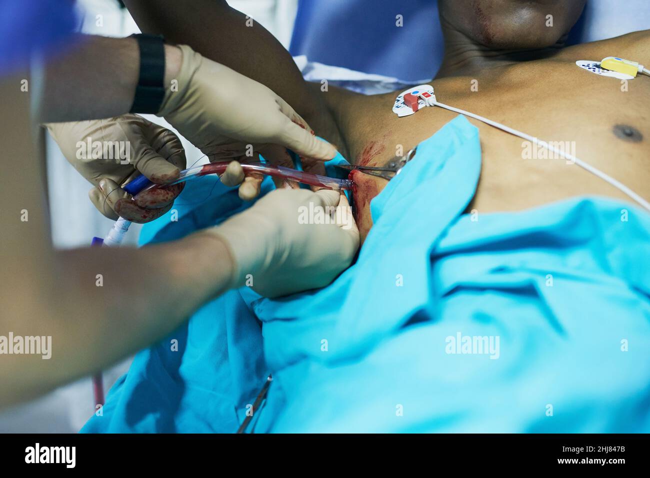 Compétences chirurgicales dans les intubations thoraciques.Prise de vue rognée d'un médecin insérant un tube dans la poitrine d'un patient dans une salle d'urgence. Banque D'Images