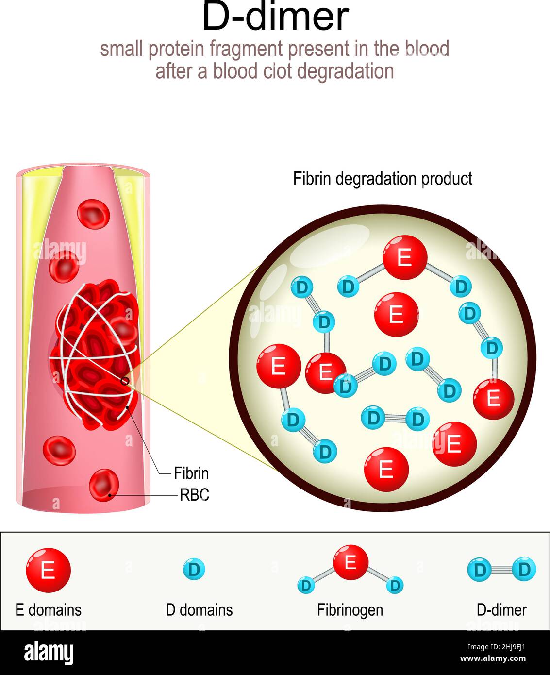 Formation de dimère-D.Vaisseau sanguin avec caillot de sang. Gros plan des produits de dégradation de la fibrine FDP. Indicateur de mauvais pronostic pour COVID-19 Illustration de Vecteur