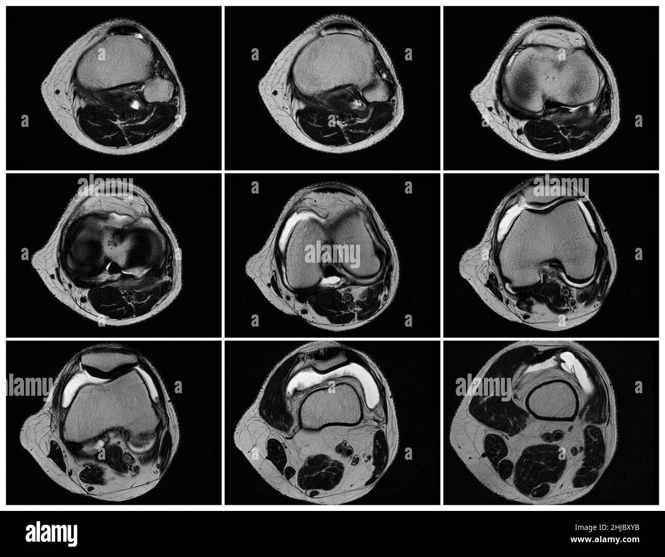 Imagerie par résonance magnétique, images MRT du genou.arthrite psoriasique aiguë, arthrose .excès de liquide synovial dans et autour de l'articulation gauche du genou Banque D'Images Imagerie par résonance magnétique, images MRT du genou.arthrite psoriasique aiguë, arthrose .excès de liquide synovial dans et autour de l'articulation gauche du genou Banque D'Images