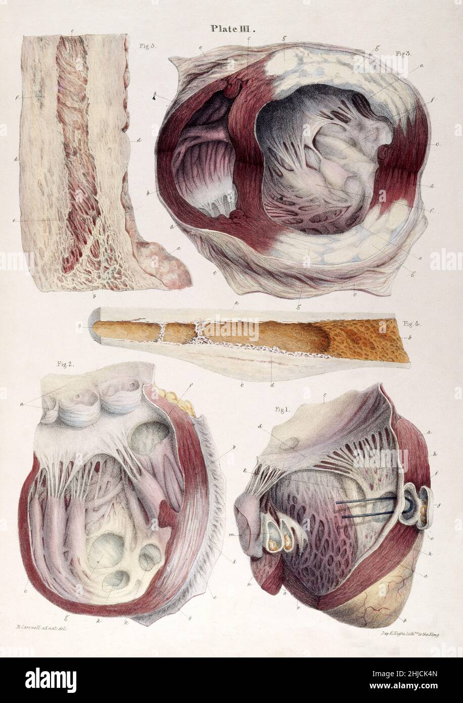 Les apparences morbides qui précèdent et accompagnent la formation de la dilatation anévrismale du coeur.Robert Carswell, 1838.Un anévrisme est un renflement localisé, rempli de sang, semblable à un ballonnet dans la paroi d'un vaisseau sanguin et peut se produire dans le cœur lui-même. Banque D'Images Les apparences morbides qui précèdent et accompagnent la formation de la dilatation anévrismale du coeur.Robert Carswell, 1838.Un anévrisme est un renflement localisé, rempli de sang, semblable à un ballonnet dans la paroi d'un vaisseau sanguin et peut se produire dans le cœur lui-même. Banque D'Images