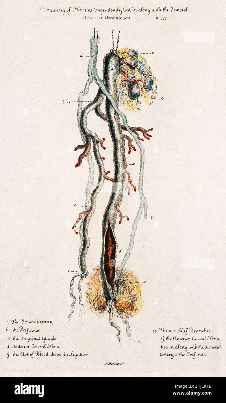 Un nerf amputé et une artère, avec un caillot de sang au-dessus de la ligature.Gravure en crépi de couleur après John Bell, c.1810. Banque D'Images