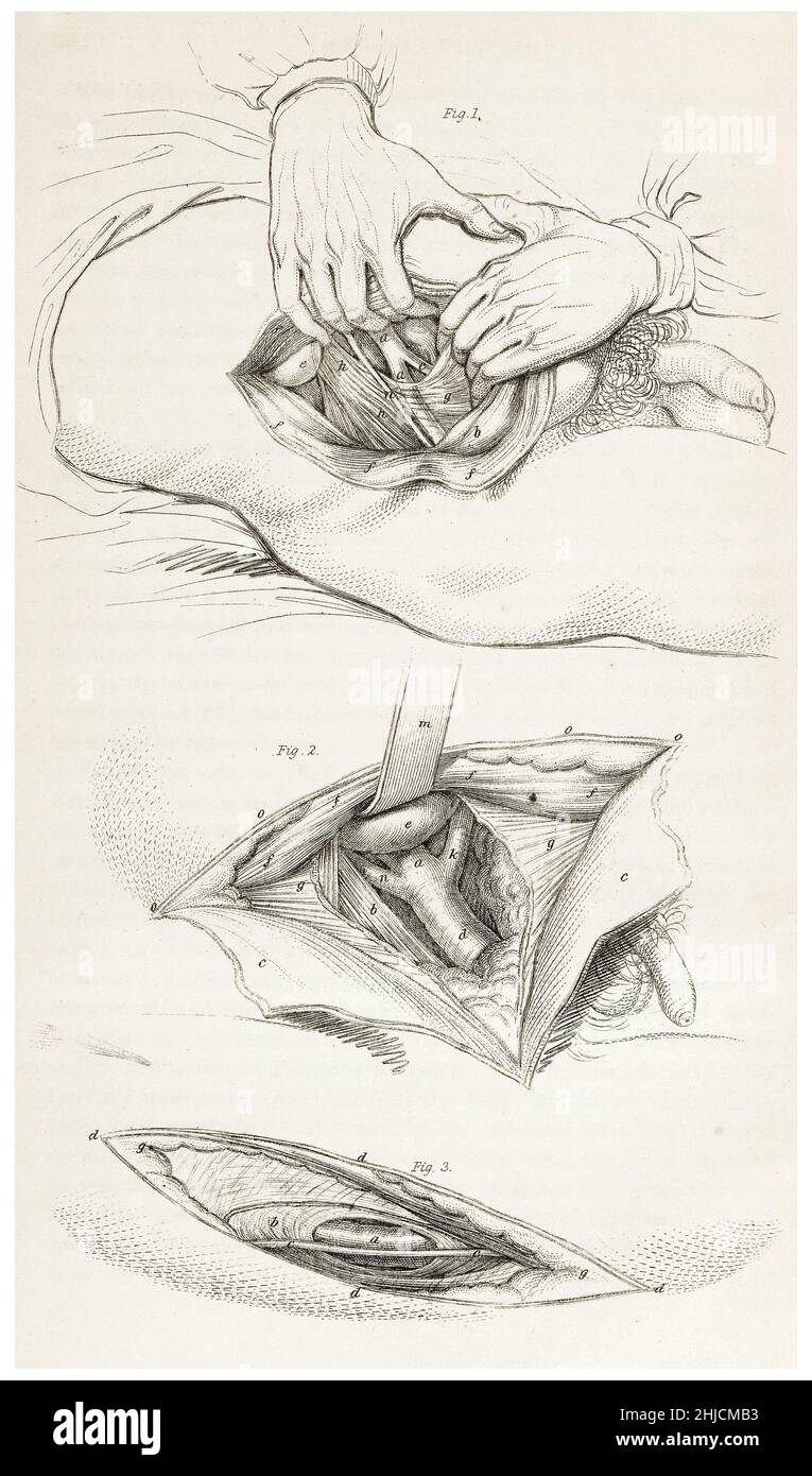 Trois diagrammes montrant l'artère fémorale.L'artère fémorale est une grande artère dans la cuisse.John Lizars, 1847. Banque D'Images