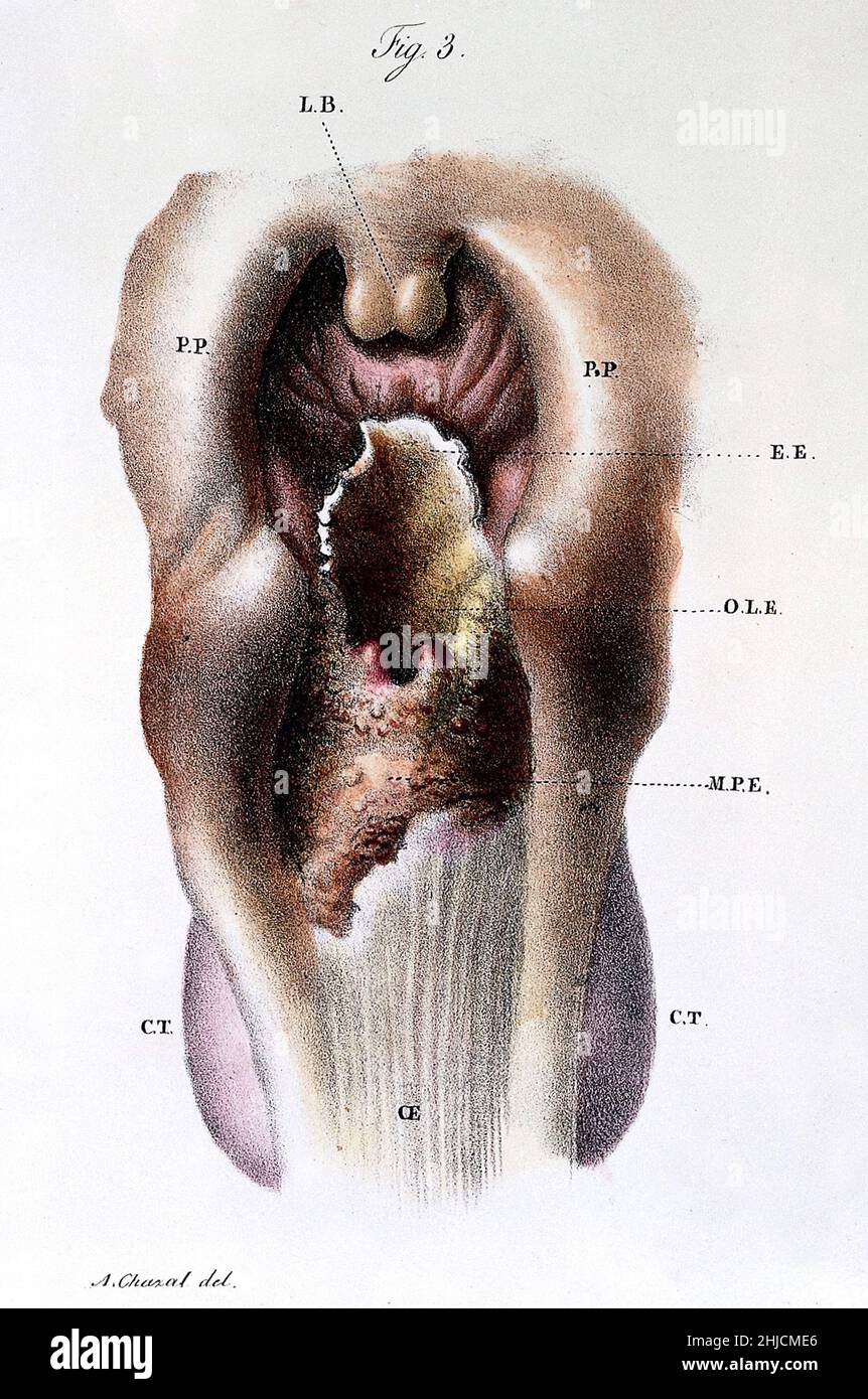 Illustration d'un larynx malade.De 'Anatomie pathologique du corps humain, édition 5th.'J. Cruveilhier, publié 1829-1842. Banque D'Images