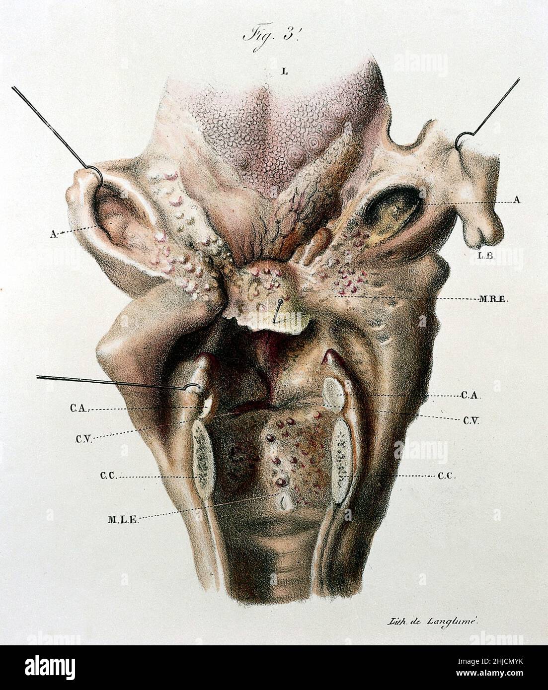 Illustration d'un larynx malade.De 'Anatomie pathologique du corps humain, édition 5th.'J. Cruveilhier, publié 1829-1842. Banque D'Images