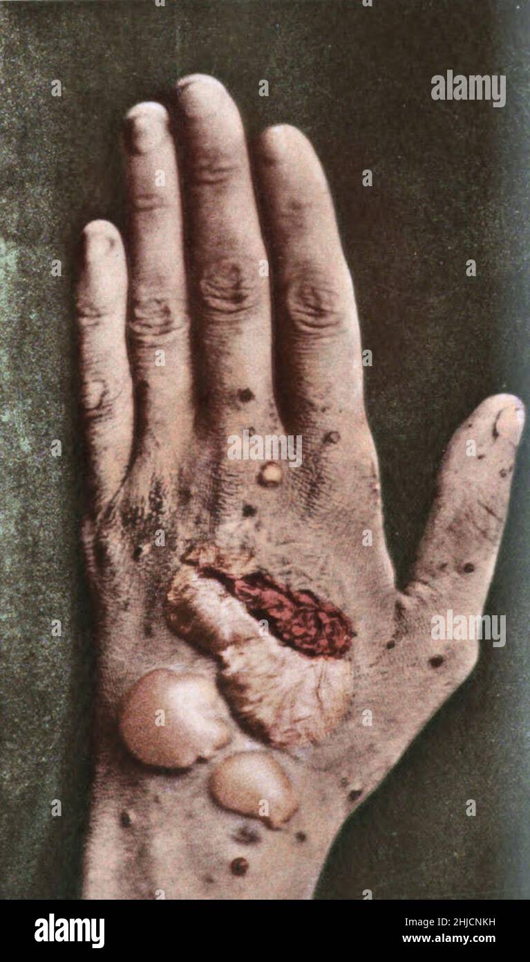 Pemphigus.Photographié par George Henry Fox, 1886.Le pemphigus est un trouble rare de la peau qui provoque des cloques et des plaies sur la peau ou les muqueuses, comme dans la bouche ou sur les organes génitaux.Les deux principaux types sont pemphigus vulgaris et pemphigus foliaceus.Pemphigus foliaceus affecte la peau. Banque D'Images Pemphigus.Photographié par George Henry Fox, 1886.Le pemphigus est un trouble rare de la peau qui provoque des cloques et des plaies sur la peau ou les muqueuses, comme dans la bouche ou sur les organes génitaux.Les deux principaux types sont pemphigus vulgaris et pemphigus foliaceus.Pemphigus foliaceus affecte la peau. Banque D'Images