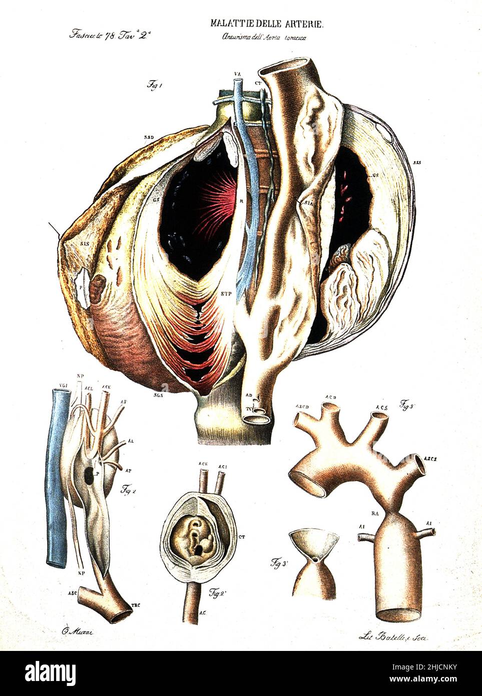 Plusieurs sections d'artère malade (anévrisme de l'aorte).Lithographie colorée de Batelli d'après Ottavio Muzzi, c.1843. Banque D'Images
