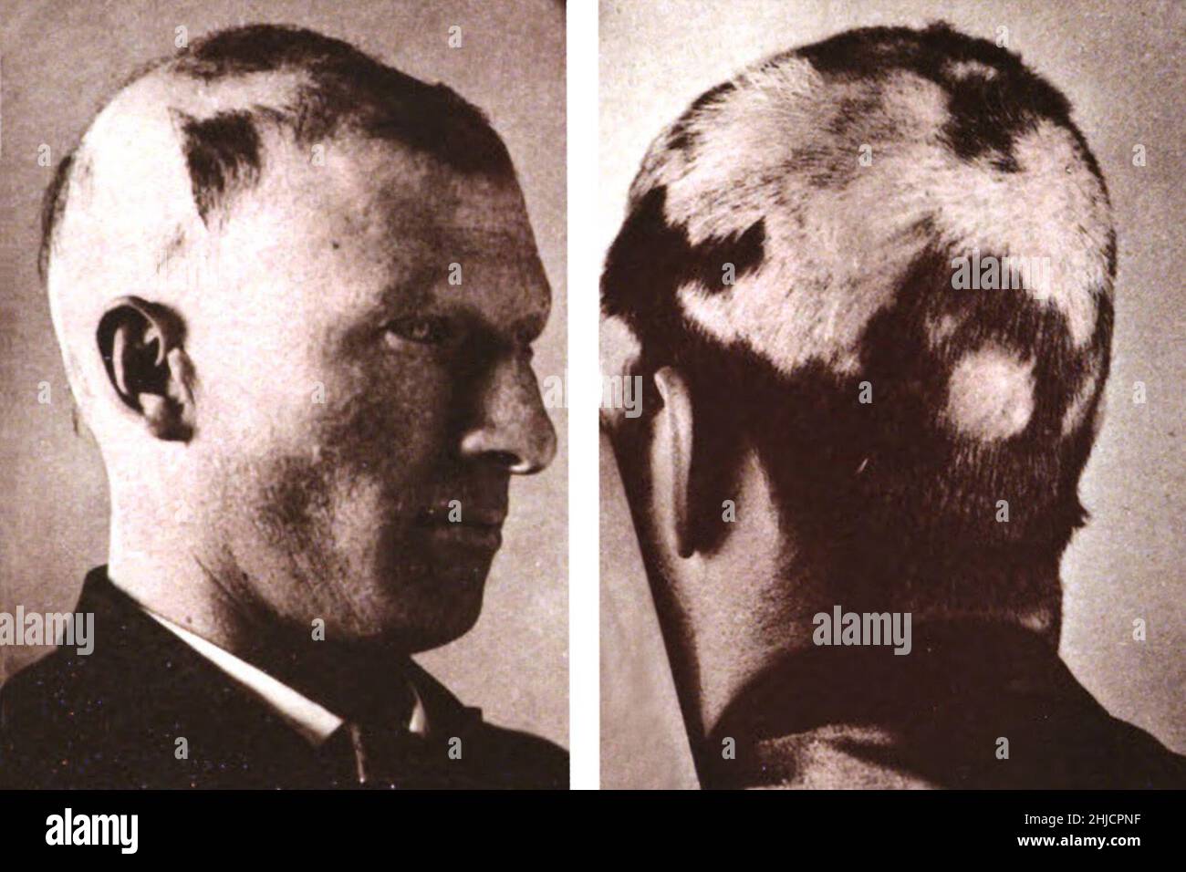 Alopécie areata, perte soudaine de cheveux qui commence avec un ou plusieurs patches circulaires chauves qui peuvent se chevaucher.Photographié par George Henry Fox, 1886. Banque D'Images