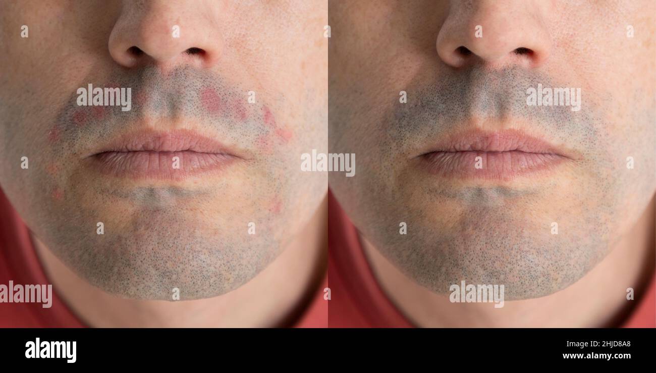 Photo avec et sans dermatite.Concept de peau irritée chez les hommes après  le rasage.Photos avant et après le traitement Photo Stock - Alamy