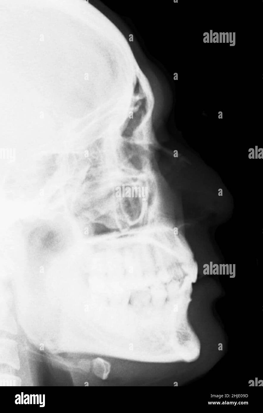 Nez fracturé, rayons X Photo Stock - Alamy