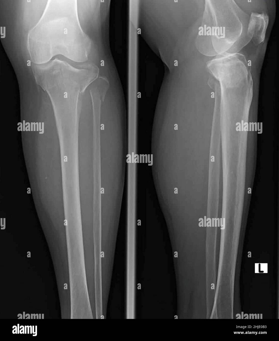 Fracture du plateau tibial Banque de photographies et d'images à haute  résolution - Alamy