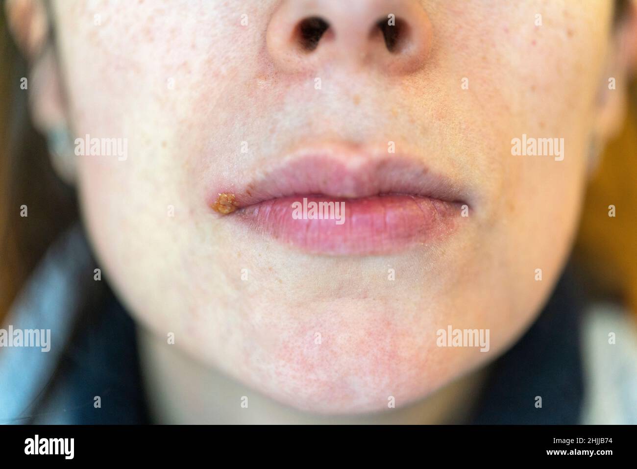 Femme avec le virus de l'herpès simplex sur sa lèvre supérieure Banque D'Images