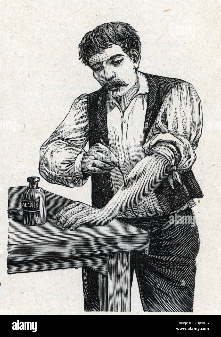 Représentation d'une cautérisation avec un produit chimique alcalin pour faire référence à une laie ou arrêter une hemorragie (cautérisation chimique (ou cautérisation, ou cautérisation) Gravure tiree de 'Medecine illustrae' 1888 Collection privee Banque D'Images