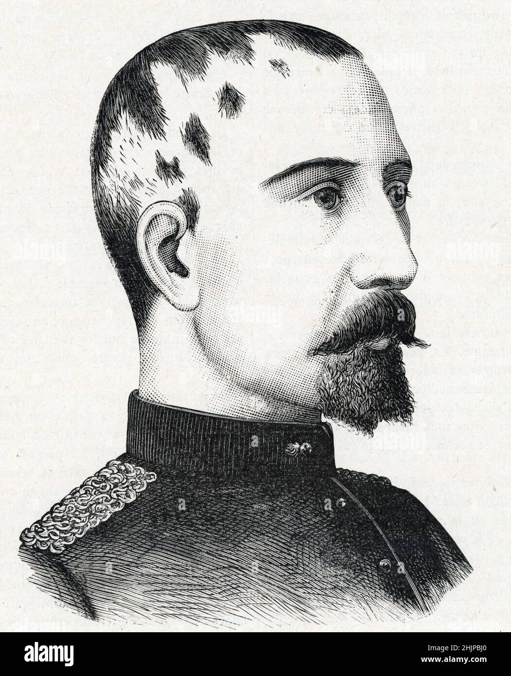 Portrait de malade attestation de pelade alopécie areata, maladie auto-immune qui provoque la chute des cheveux (homme avec la maladie de la perte de cheveux) Gravure tiree de 'taille illustrae' 1888 Collection privee Banque D'Images