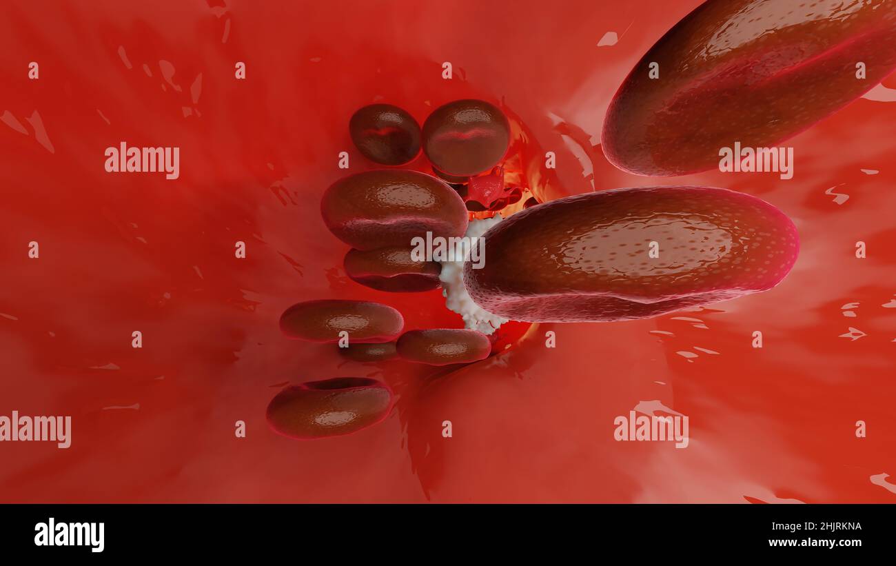 Hémostase. Globules rouges et plaquettes dans le vaisseau sanguin. Étapes de base du processus de cicatrisation des plaies. illustration 3d Banque D'Images