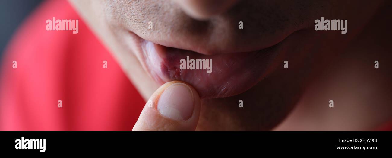 Sur l'herpès labial mâle de l'intérieur de gros plan Banque D'Images Sur l'herpès labial mâle de l'intérieur de gros plan Banque D'Images