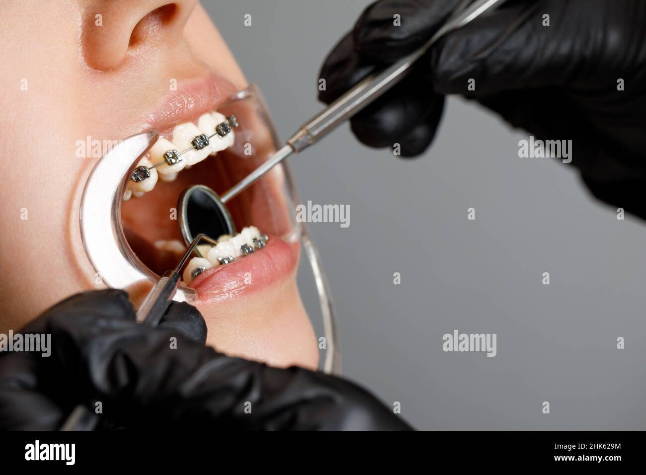 Une jeune femme avec des bretelles métalliques est examinée par un orthodontiste.Correction de la morsure des dents dans la clinique dentaire.Concept de dents saines. Banque D'Images