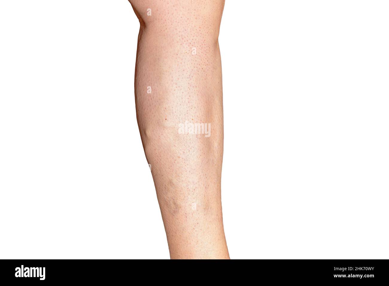Jambe d'une femme avec une insuffisance veineuse chronique de grade C3-C4.Photographie des jambes isolée sur fond blanc Banque D'Images