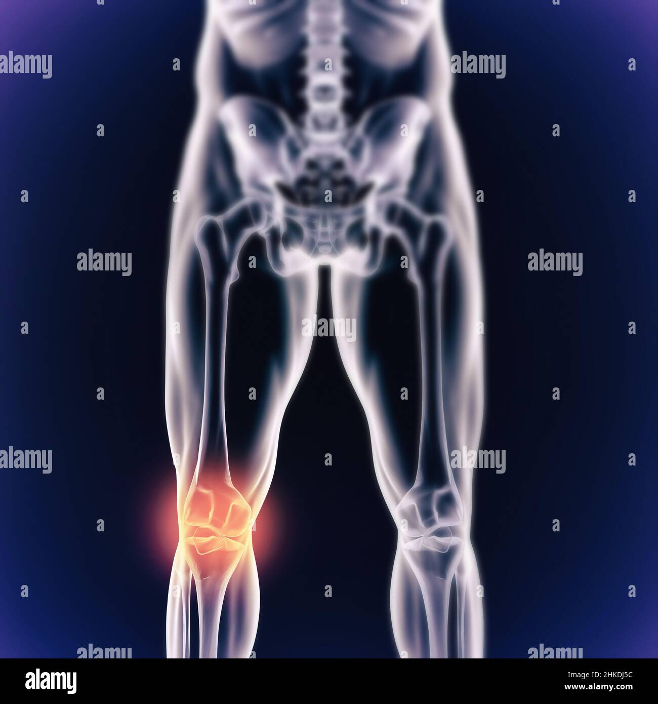 Quand l'inflammation frappe.Vue cgi d'un joint enflammé isolé en bleu. Banque D'Images