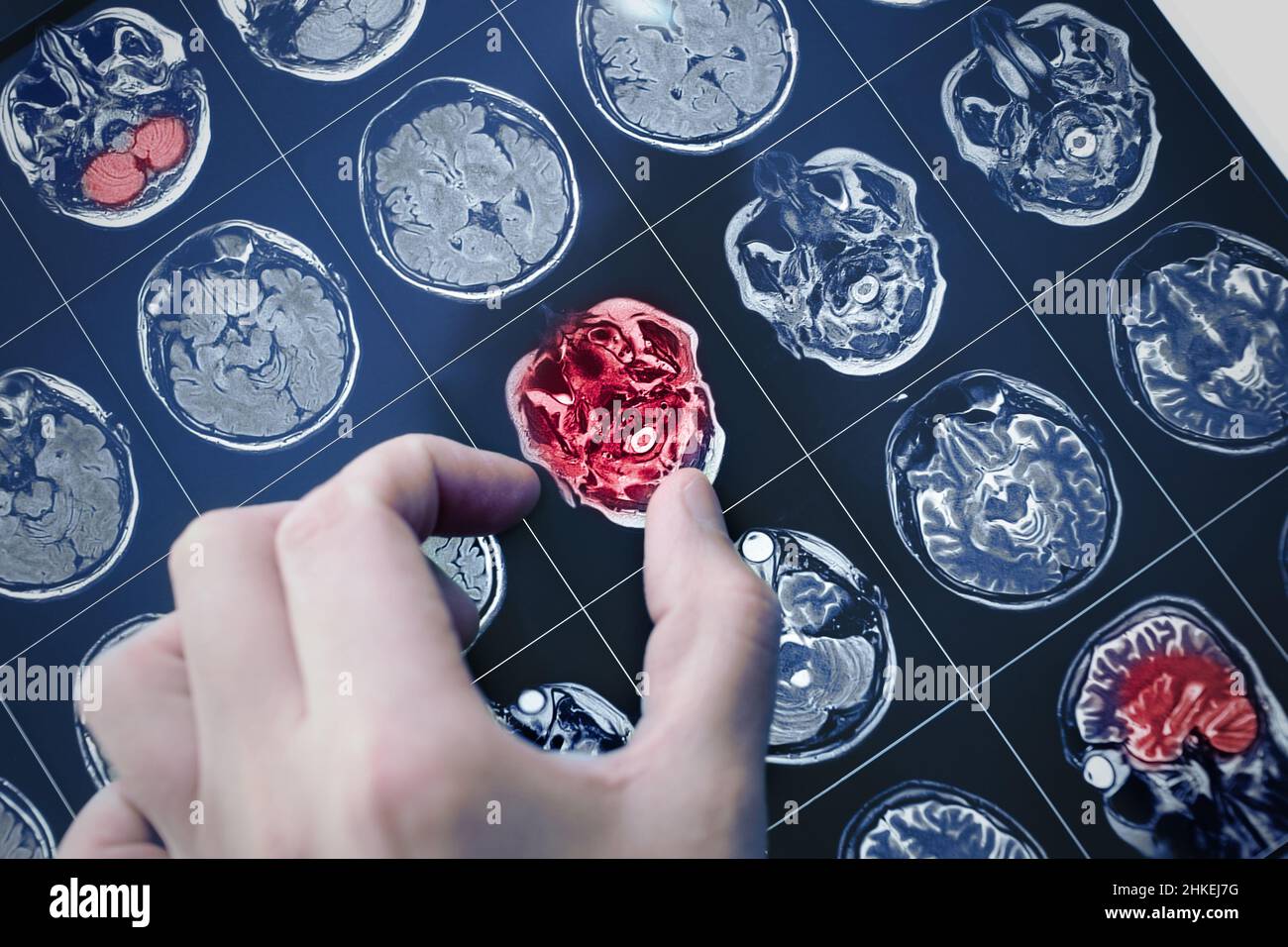 L'image IRM du cerveau du patient avec la main du médecin pointant vers le problème. Banque D'Images